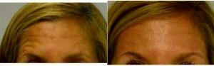 Doctor Jonathan Hall, MD, Boston Plastic Surgeon - 51 Year Old Woman Treated With Botox Who Does Not Like Her Forehead Lines Above The Brows At Rest