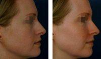 Doctor Jonathan Kulbersh, MD, Charlotte Facial Plastic Surgeon - 32 Year Old Woman Treated With Restylane