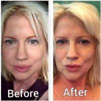 Doctor Jordan C. Carqueville, Chicago Plastic Surgeon Botox Type A Before And After For 11 Lines