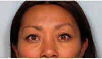 Doctor Joseph A. Eviatar, MD, FACS, New York Oculoplastic Surgeon - 38 Year Old Woman Treated With Restylane