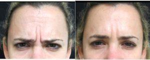 Doctor Joshua Lampert, MD,FACS, Miami Plastic Surgeon - 41 Year Old Woman Treated With Botox