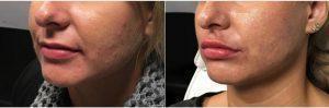 Doctor Justin Harper, MD, Columbus Physician - 34 Year Old Woman Treated With Juvederm Ultra