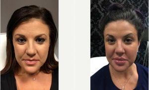 Doctor Justin Harper, MD, Columbus Physician - 43 Year Old Woman Treated With Juvederm