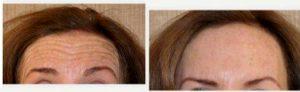 Doctor Karan Dhir, MD, Beverly Hills Facial Plastic Surgeon - 43 Year Old Woman Treated With Botox And Restylane