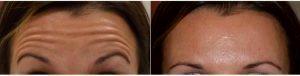 Doctor Karol A. Gutowski, MD, FACS, Chicago Plastic Surgeon - 33 Year Old Woman Treated With Botox For Forehead Lines