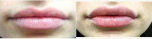 Doctor Kate Kleydman, DO, New York Dermatologic Surgeon - Juvederm Lip Enhancement