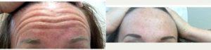 Doctor Katina Miles, MD, Bowie Dermatologist - 53 Year Old Woman Treated With Botox And Restylane