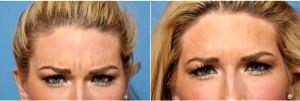 Doctor Kian Karimi, MD, FACS, Los Angeles Facial Plastic Surgeon - Preventative Botox -- Treating Wrinkles They Become Permanent