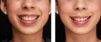 Doctor Leyda Elizabeth Bowes, MD, Miami Dermatologic Surgeon - Gummy Smile Treated With Botox
