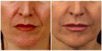 Doctor Louis W. Apostolakis, MD, Austin Facial Plastic Surgeon - Restylane For Lips