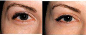 Doctor Marc Cohen, MD, Philadelphia Oculoplastic Surgeon - 44 Year Old Woman Treated With Botox