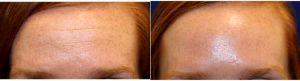 Doctor Matthew Richardson, MD, Frisco Facial Plastic Surgeon - Botox To Forehead And Glabella Before And After
