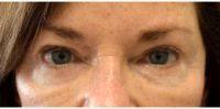 Doctor Mehryar (Ray) Taban, MD, FACS, Beverly Hills Oculoplastic Surgeon - Botox Injection To Correct Eye And Eyebrow Asymmetry.