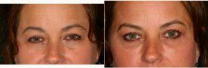 Doctor Michael Bowman, MD, Roanoke Facial Plastic Surgeon - 35 Year Old Woman Treated With Restylane, Perlane And Botox