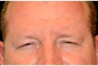 Doctor Michael Law, MD, Raleigh-Durham Plastic Surgeon - 28 Year Old Man Treated With Botox