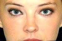 Doctor Michael R. Menachof, MD, Greenwood Village Facial Plastic Surgeon - Restylane Injected Under The Eyes