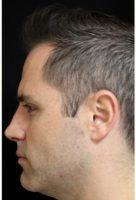 Doctor Michele S. Green, MD, New York Dermatologist - 30 Year Old Man Treated With Botox