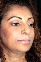 Doctor Michele S. Green, MD, New York Dermatologist - 35 Year Old Woman Treated With Juvederm
