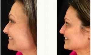 Doctor Michele S. Green, MD, New York Dermatologist - 39 Year Old Woman Treated With Botox