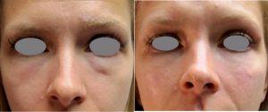 Doctor Michelle Hure, MD, San Juan Capistrano Physician - 33 Year Old Woman With Dark Circles Treated With Restylane