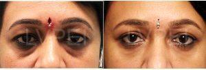 Doctor Milind Naik, MD, India Ophthalmologist - 39 Year Old Woman Treated With Juvederm