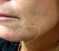 Doctor Mitchell Chasin, MD, Livingston Physician - 48 Year Old Woman Treated With Subcision And Juvederm For Indented Scar From Steroid Injection