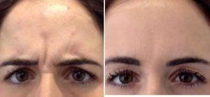Doctor Munir Somji, BSc, MBBS, London Physician - 34 Year Old Woman Treated With Botox for A Furrowed Brows
