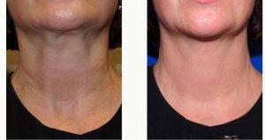 Doctor Myriam Loyo, MD, Portland Facial Plastic Surgeon - Neck Bands Treated With Botox