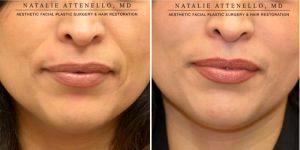 Doctor Natalie Attenello, MD, Beverly Hills Facial Plastic Surgeon - Juvederm To Soften The Smile Lines