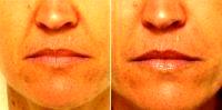 Doctor Nima Shemirani, MD, Beverly Hills Facial Plastic Surgeon - Smile Lines Treated With Restylane