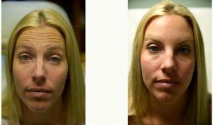 Doctor Peter N. Butler, MD, Pensacola Plastic Surgeon - 34 Year Old Woman Treated With Botox For Forehead Wrinkles