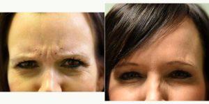 Doctor Peter N. Butler, MD, Pensacola Plastic Surgeon - 40 Year Old Woman Treated With Botox