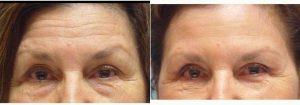 Doctor Peter T. Truong, MD, Fresno Oculoplastic Surgeon - 60 Year Old Woman Treated With Botox And Restylane In Forehead