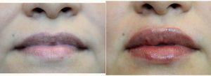 Doctor Regina Rodman, MD, Houston Facial Plastic Surgeon - 41 Year Old Woman Treated With Juvederm
