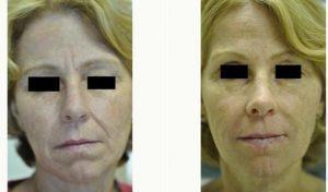 Doctor Renuka Diwan, MD, Cleveland Dermatologic Surgeon - 50 Year Old Woman Treated With Botox And Juvederm