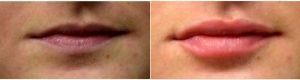 Doctor Richard G. Reish, MD, FACS, New York Plastic Surgeon - 19 Year Old Woman Treated With Juvederm