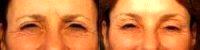 Doctor Richard W. Fleming, MD, Beverly Hills Facial Plastic Surgeon - Botox Between Eyebrows