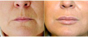Doctor Robert W. Sheffield, MD, Santa Barbara Plastic Surgeon - 50 Year Old Woman Treated With Restylane
