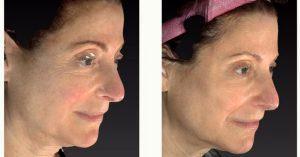Doctor Roni Munk, MD, Montreal Dermatologic Surgeon - 56 Year Old Woman Treated With Botox Injections
