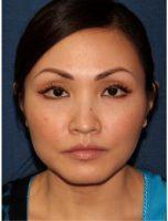Doctor Sabrina Fabi, MD, San Diego Dermatologic Surgeon - 42 Year Old Woman Treated With Botox