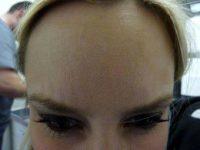 Doctor Samantha Toerge, MD, Chevy Chase Dermatologic Surgeon - Botox- Forehead