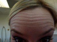 Doctor Samantha Toerge, MD, Chevy Chase Dermatologic Surgeon - Botox- Forehead