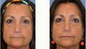 Doctor Satyen Undavia, MD, Philadelphia Facial Plastic Surgeon - 48 Year Old Woman Treated With Restylane