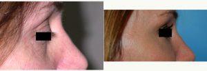 Doctor Sharon Y. Giese, MD, New York Plastic Surgeon - 43 Year Old Woman Treated With Juvederm