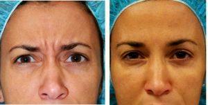 Doctor Shaun Patel, MD, Miami Physician - 41 Year Old Female Treated With Botox For Frown Lines
