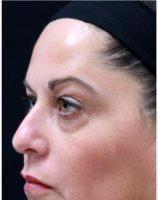 Doctor Shaun Patel, MD, Miami Physician - 51 Year Old Female Treated With Botox For Crow's Feet And Eyebrow Raise