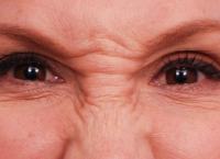 Doctor Sirius K. Yoo, MD, San Diego Facial Plastic Surgeon - Botox For Frown Lines