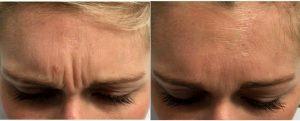 Doctor Steven F. Weiner, MD, Panama City Facial Plastic Surgeon - 34 Year Old Woman Treated With Botox