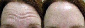 Doctor Tatiana Khrom, MD, New York Dermatologic Surgeon - Dysport For Horizontal Forehead Lines