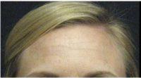 Doctor Thomas G. Kotoske, DO, Phoenix Facial Plastic Surgeon - 31 Year Old Woman Treated With Botox